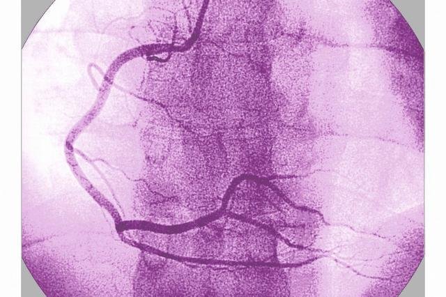 做心脏造影多少钱?