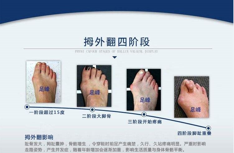 脚拇指外翻是怎样造成的?