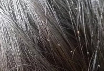 头上长虱子怎么办