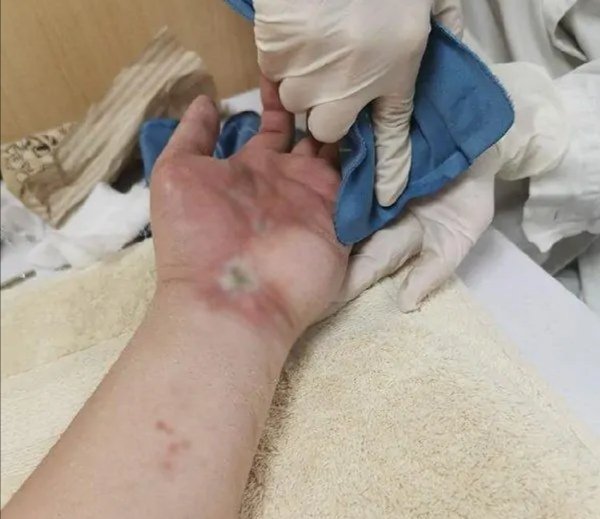 被砍伤84天的陶勇医生出院，他的职业生涯是否会因此戛然而止？