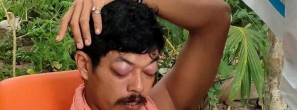 生命太脆弱，男子被一个突然掉落的椰子砸中头，最终经抢救无效死亡！