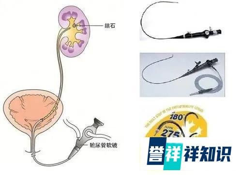 深圳厚德结石专科：输尿管软镜碎石——微创治疗肾结石的新选择