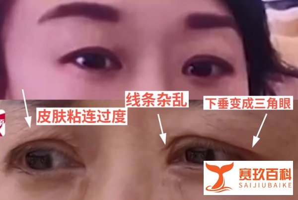 如何看待热搜“双眼皮失败老公闹离婚”?