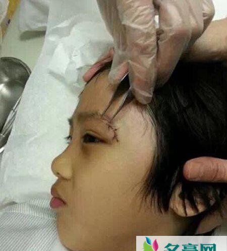 吴镇宇儿子眼睛受伤缝针 吴镇宇儿子受伤原因