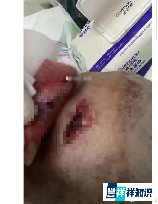 女孩被打碎头骨后续，老师疑惯犯背景不简单，本砸另一学生误伤女孩