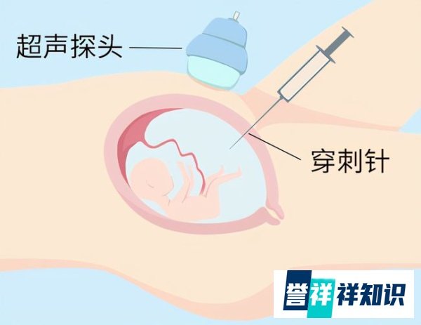 上海新华医院羊水穿刺攻略:手术流程、费用参考、注意事项、结果报告等