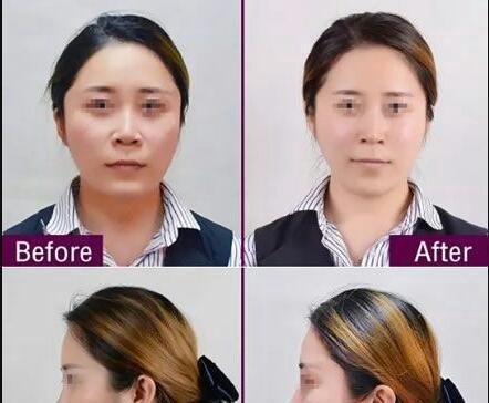 小艾讲医美|同样是玻尿酸，乔雅登凭什么这么贵